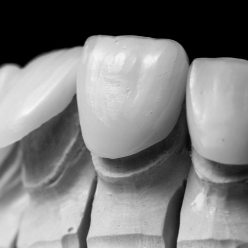 licówki zębowe wrocław