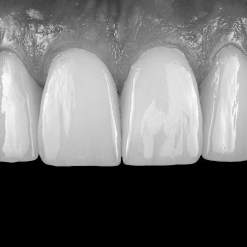 Cennik Bonding Licówki cena